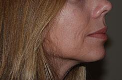 Dermal Fillers & Injectables Before & After Image