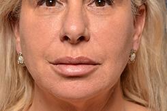 Dermal Fillers & Injectables Before & After Image