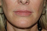 Lip Augmentation Before & After Image