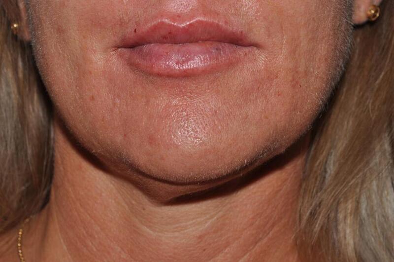 Lip Augmentation Before & After Image